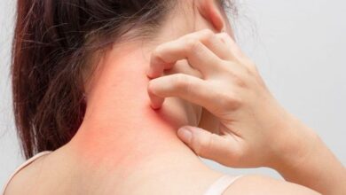 Eczema Natural Treatment Egzama neden olur, bulaşıcı mı, nasıl geçer? Saraçoğlu egzama kürü