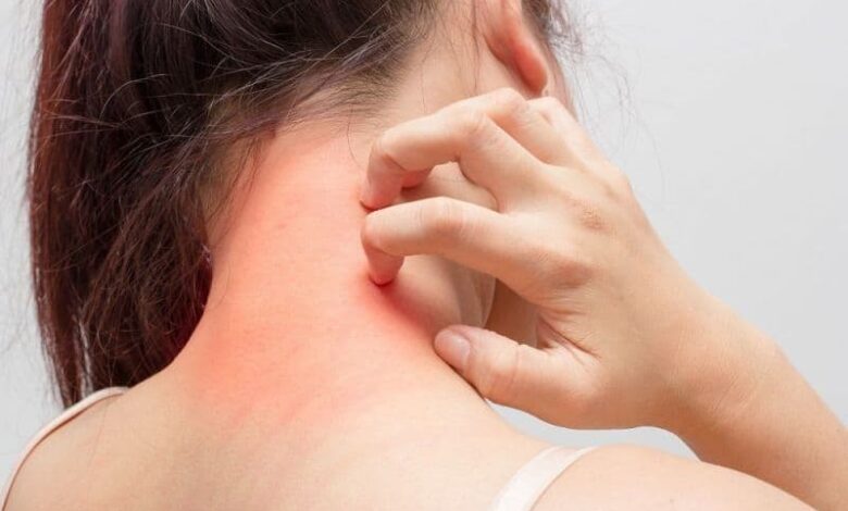 Eczema Natural Treatment Egzama neden olur, bulaşıcı mı, nasıl geçer? Saraçoğlu egzama kürü