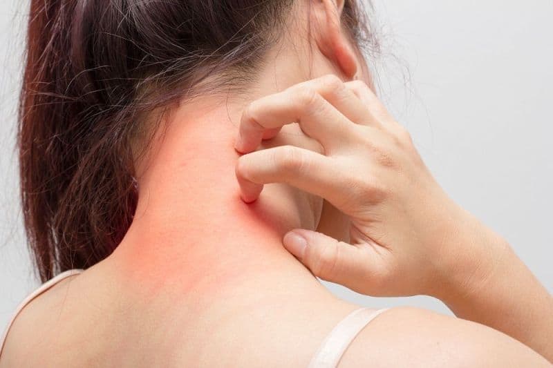 Eczema Natural Treatment Egzema Neden Olur, Bulaşıcı Mıdır, Nasıl Geçer? İbrahim Saraçoğlu Egzema Kürü