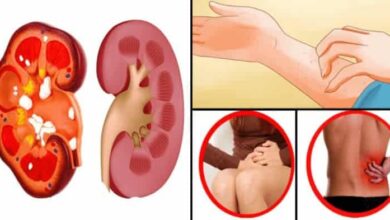 bobrek kanseri nedir belirtileri nelerdir Böbrek Kanseri Nedir?