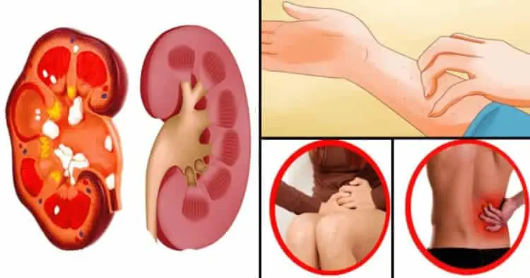 Böbrek Kanseri Nedir? 1 bobrek kanseri nedir belirtileri nelerdir Böbrek Kanseri Nedir?