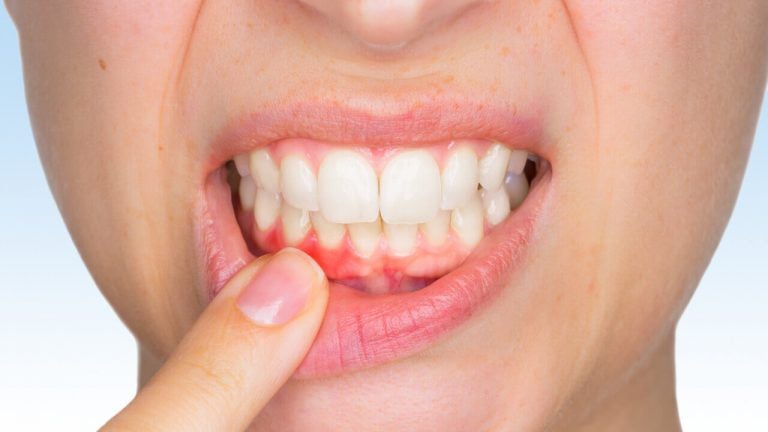 Diş Eti Kanaması Neden Önemlidir? Tedavisi Diş Sağlığı