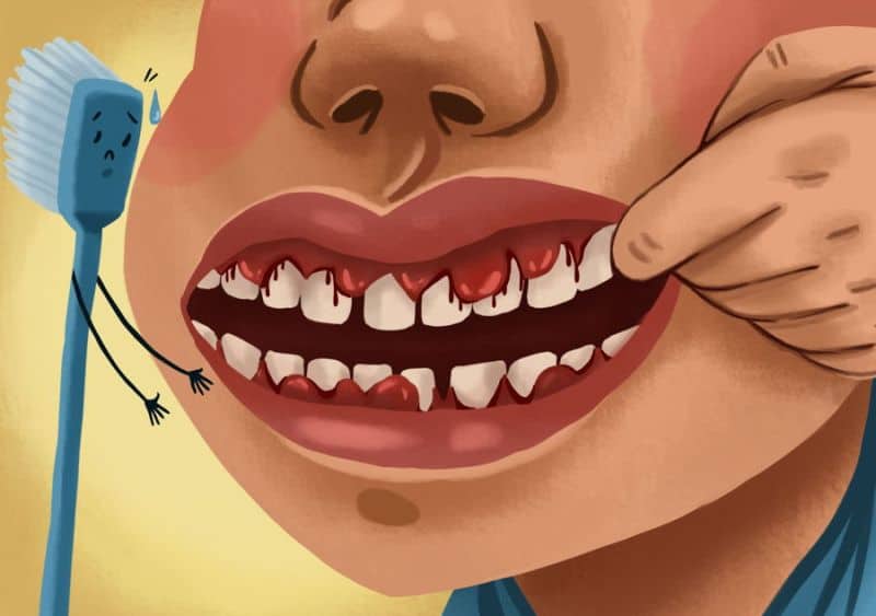 Diş Eti Kanaması Neden Önemlidir? Tedavisi Sağlık Haberleri