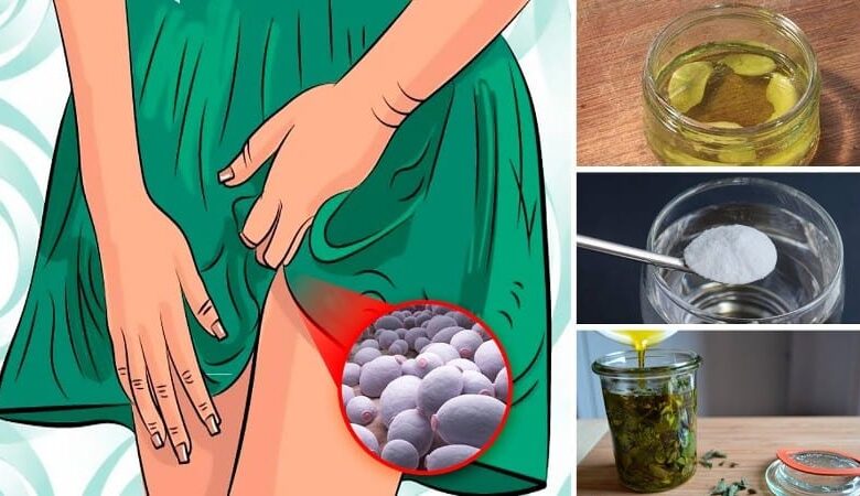 Vajinal Mantar Enfeksiyonu Nedir, Neden Olur? Belirtileri ve Tedavisi