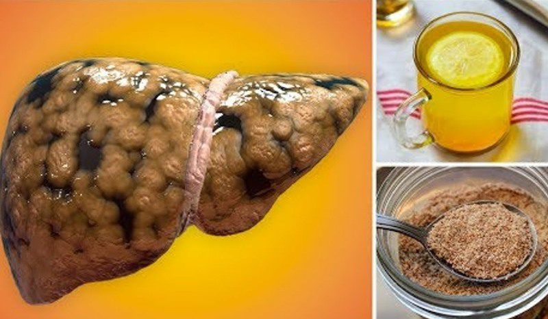 Karaciğer Yağlanması Neden Olur, Nasıl Temizlenir? Bitkisel Tedavisi