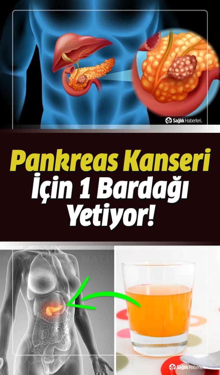 Pankreas Kanseri Belirtileri ve Evreleri Neler? Ameliyatı ve Bitkisel Tedavisi