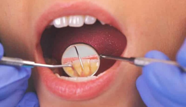 Diş eti çekilmesi neden olur? Evde diş taşı temizliği Haberler