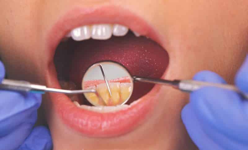 Diş eti çekilmesi neden olur? Evde diş taşı temizliği