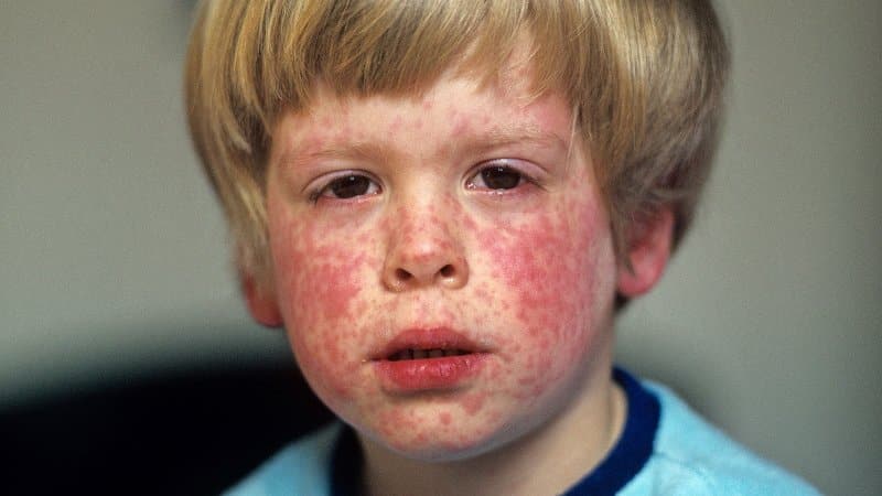 Kızamık hastalığı ne kadar tehlikeli?