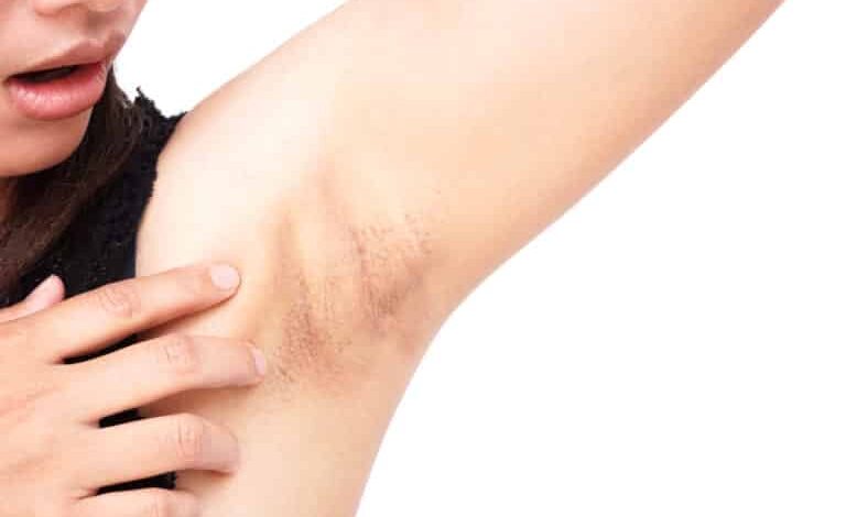 Koltuk altı ve bikini bölgesi kararması neden olur, nasıl geçer? Bitkisel çözüm