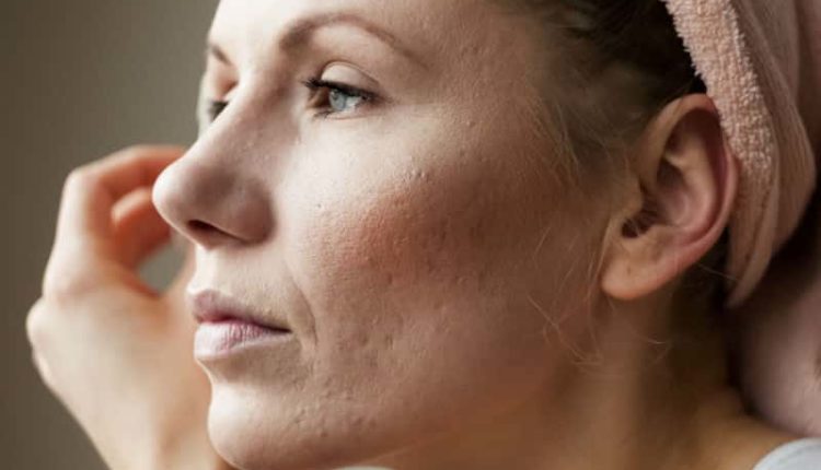 Sivilce izleri nasıl geçer? Sivilce izleri için doğal maske tarifleri