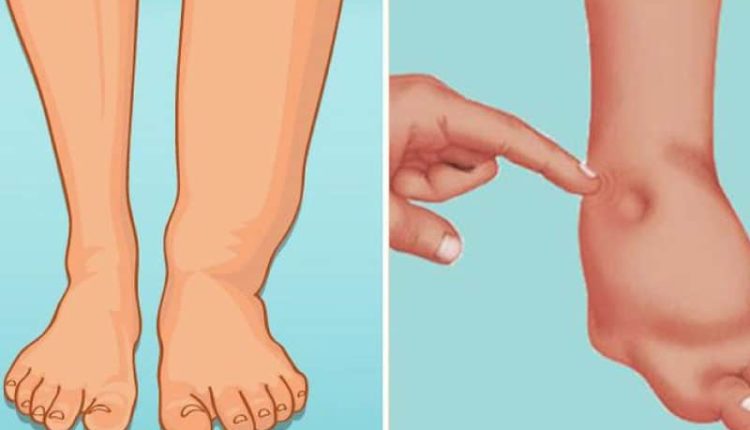 Bacak şişmesi neden olur, sebepleri neler, nasıl geçer? Tedavisi