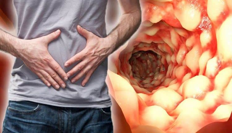 Chorn hastalığı nedir, sebepleri neler, kanser mi? Nasıl tedavi edilir?
