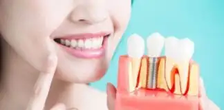 Dental implant (diş implantı) nedir, nasıl yapılır? Kimlere yapılmaz?