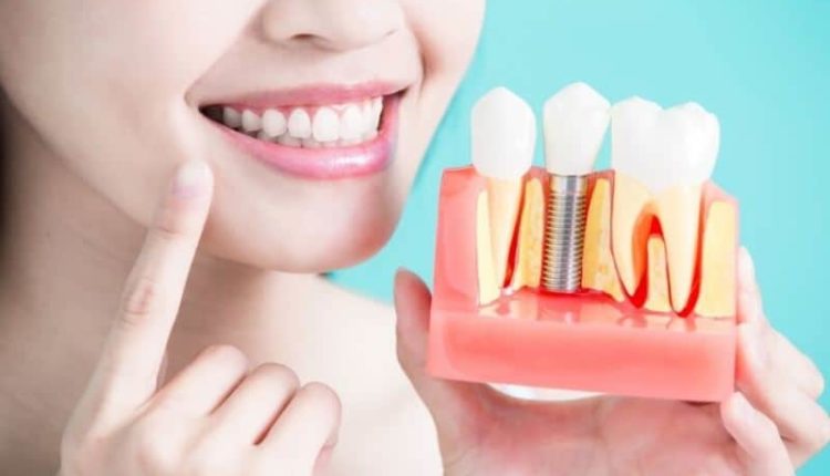 Dental implant (diş implantı) nedir, nasıl yapılır? Kimlere yapılmaz?