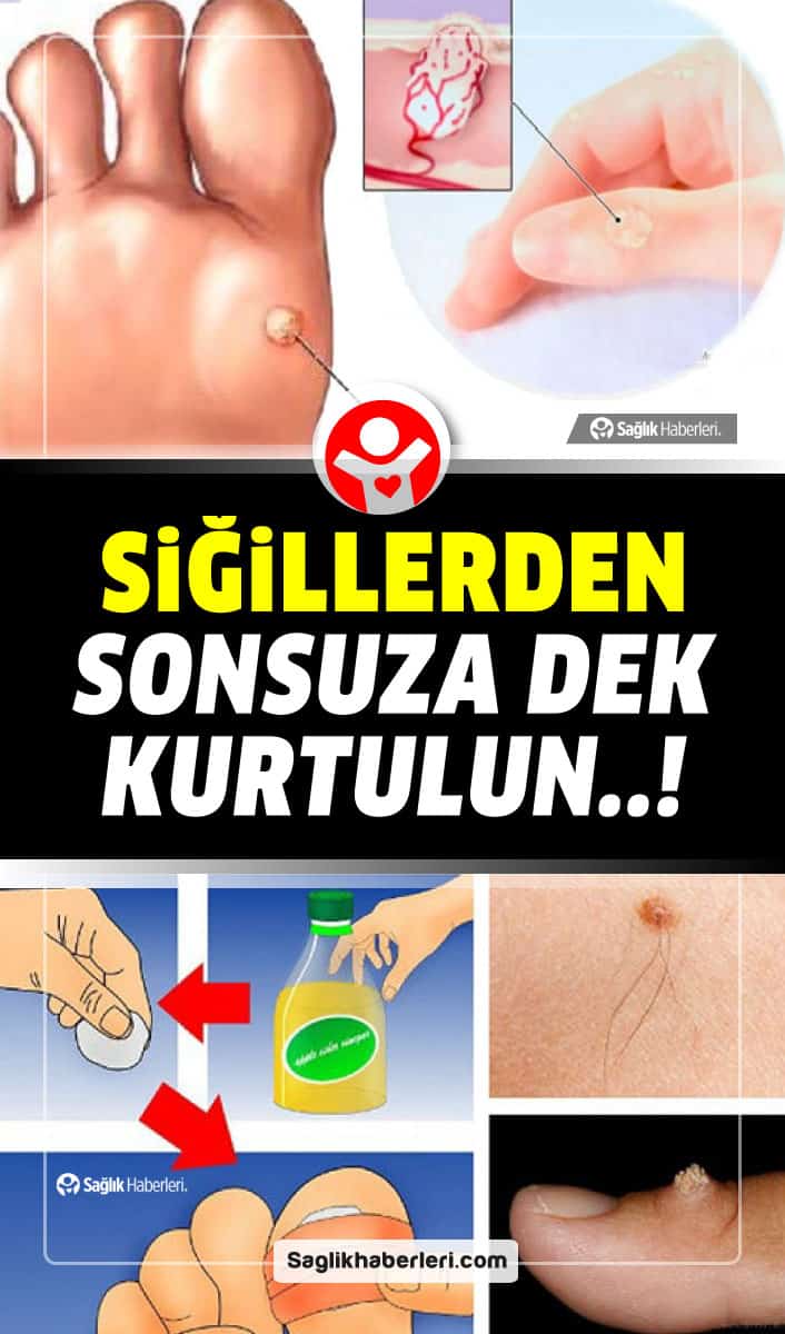Tek bir madde ile siğillerden doğal olarak kurtulun!