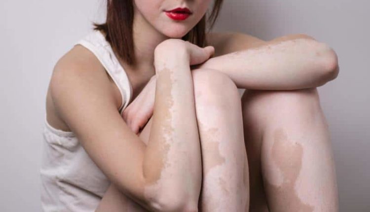 Vitiligo nedir? Vitiligo belirtileri ve nedenleri nelerdir? Bitkisel tedavisi