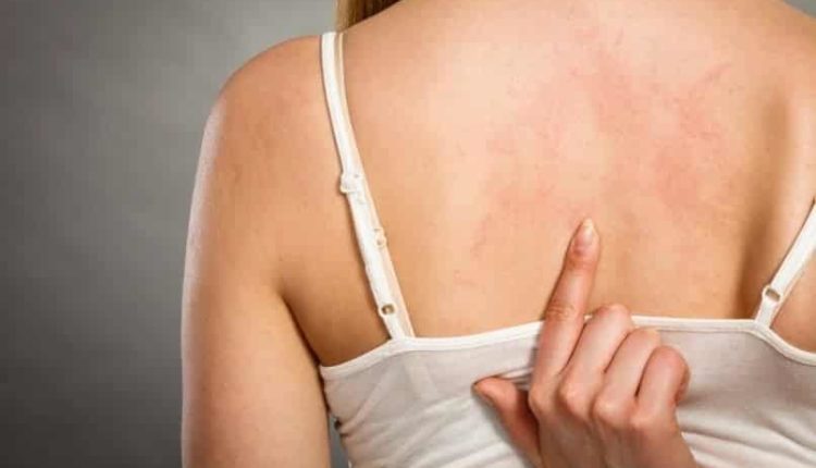 Zona hastalığı nedir, belirtileri, tedavisi, ne iyi gelir? Saraçoğlu zona kürü