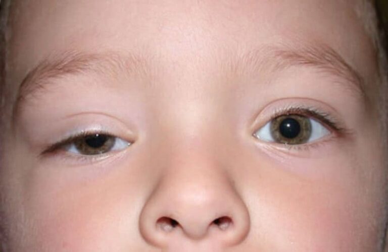 Bebeklerde göz kapağı düşüklüğü neden olur, nasıl geçer evde? Bitkisel