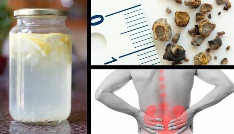 Böbrek taşı nasıl düşürülür? Böbrek taşları için doğal ev çözümleri