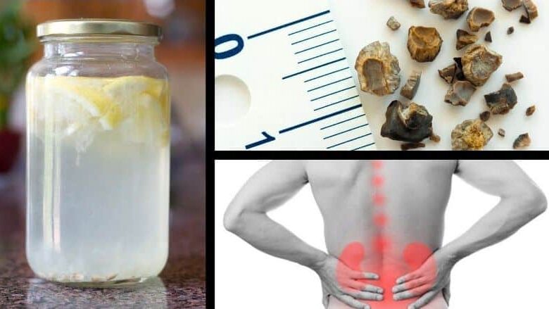Böbrek taşı nasıl düşürülür? Böbrek taşları için doğal ev çözümleri