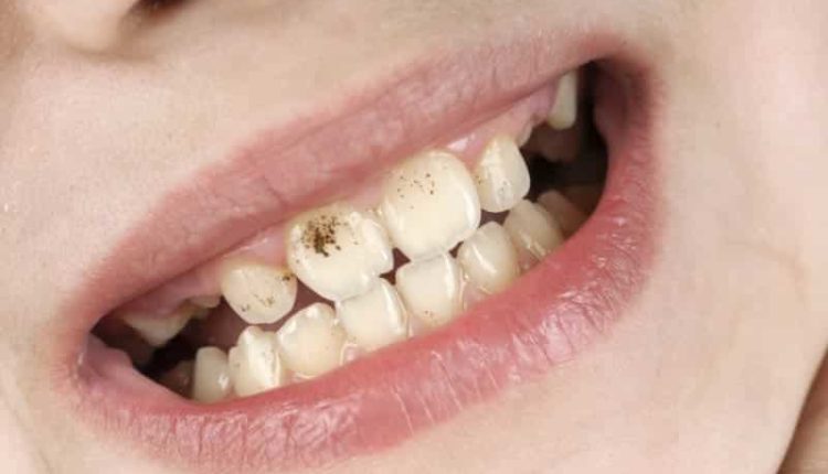 Diş çürükleri nasıl önlenir? Diş çürüklerine karşı beyaz peynir