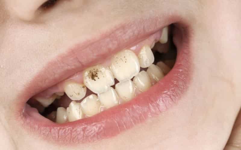 Diş çürükleri nasıl önlenir? Diş çürüklerine karşı beyaz peynir
