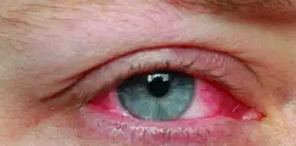Pembe göz hastalığından kurtulmak için 5 öneri!