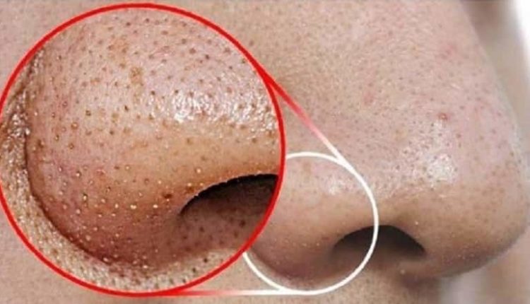 Yüzdeki ve ciltteki siyah noktaların beneklerin bitkisel yöntemlerle tedavisi