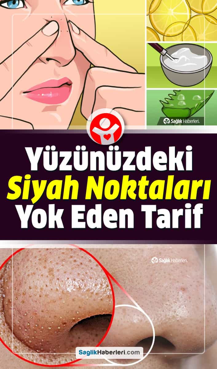 Yüzdeki ve ciltteki siyah noktaların beneklerin bitkisel yöntemlerle tedavisi