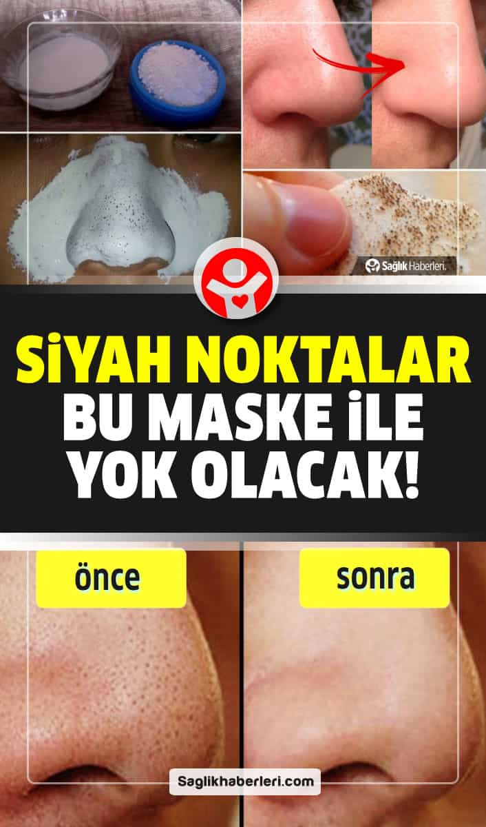 Doğal olarak siyah noktalar evde nasıl yok edilir?