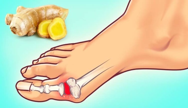 Doğal yollarla evde ürik asit nasıl düşürülür?