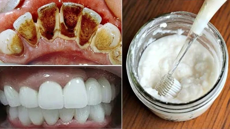 Karbonat İle Dişlerinizi Fırçalayın