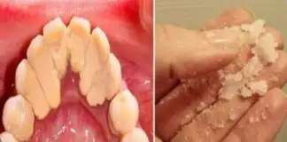 Plak ve tartarlar doğal yollarla dişlerden nasıl çıkarılır?