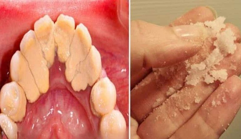 Plak ve tartarlar doğal yollarla dişlerden nasıl çıkarılır?