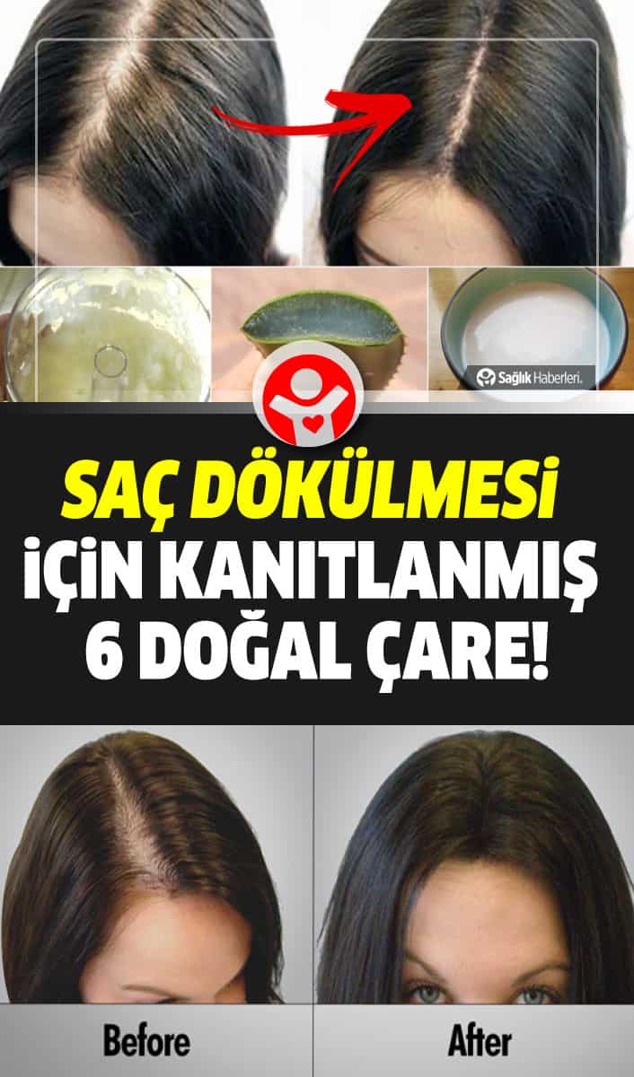 Saç dökülmesi için kanıtlanmış 6 doğal çare