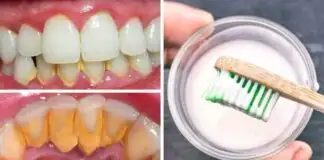 Diş taşı neden oluşur, diş taşı evde doğal yollarla nasıl temizlenir?