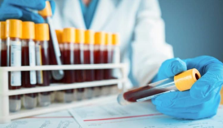 MCHC nedir ne demek? MCHC düşüklüğü ve yüksekliği nedir? Tedavisi?