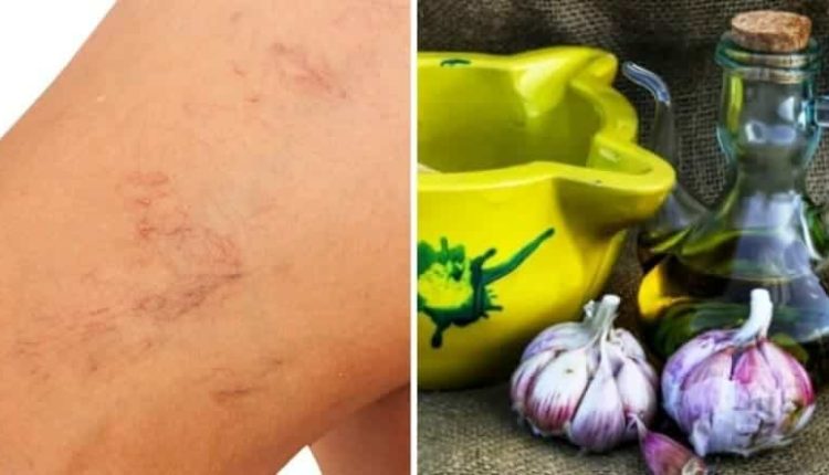Varis nasıl geçer? Sarımsak ile evde varis tedavisi