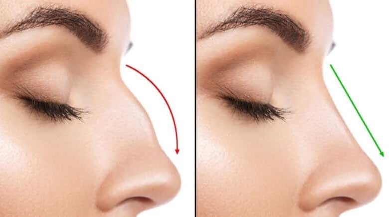 SGK veya sağlık sigortası burun estetiği ameliyatını karşılar mı? 1 SGK veya sağlık sigortası burun estetiği ameliyatını karşılar mı?
