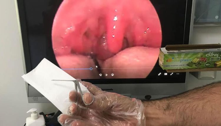 Balık sezonuyla birlikte kılçık batması şikayetleri arttı