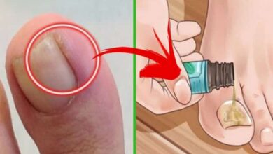 Batık tırnaklar neden olur? Batık tırnakları tedavi etmek için doğal tarif!