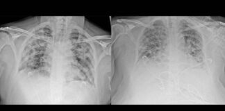 Koronavirüsün akciğere verdiği hasarı tomografi görüntülüyor