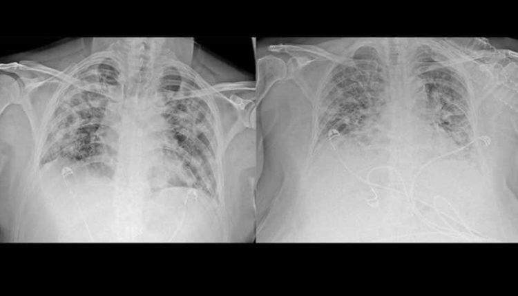Koronavirüsün akciğere verdiği hasarı tomografi görüntülüyor