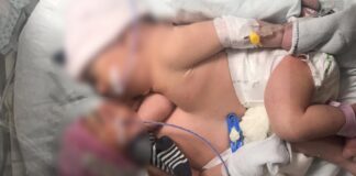 Karından ve göğüsten yapışık halde dünyaya gelen ikizler operasyonla birbirinden ayrıldı