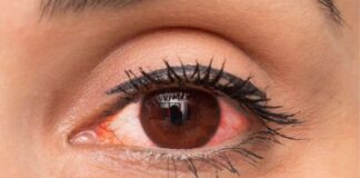 Göz kızarıklığı sebepleri nelerdir? Nasıl tedavi edilir?
