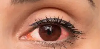 Göz kızarıklığı sebepleri nelerdir? Nasıl tedavi edilir?
