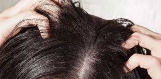 Saçtaki kepek neden olur, nasıl geçer, temizlenir? Bitkisel tedavisi