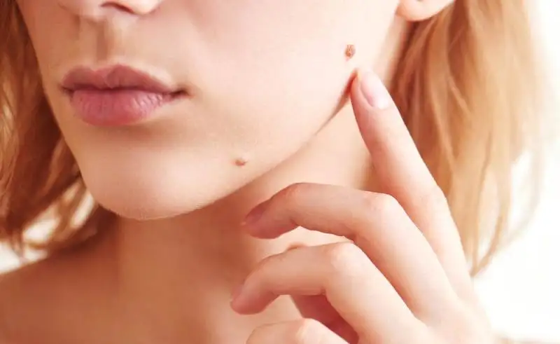 Yüzdeki kahverengi benler nasıl geçer, alınır mı? Saraçoğlu