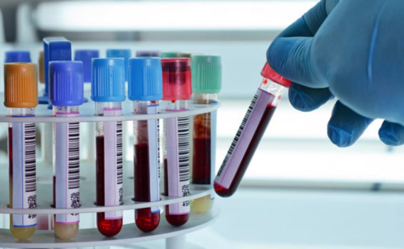 Hemogram kan testinde nelere bakılır, aç karnına mı yapılır? 1 Hemogram kan testinde nelere bakılır, aç karnına mı yapılır?